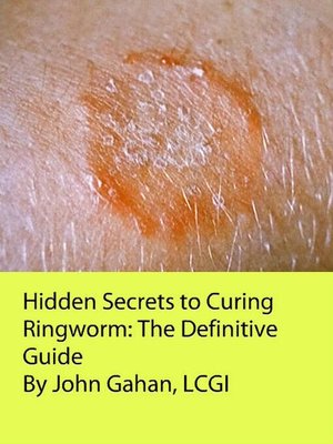 cover image of Hidden Secrets to Curing Ringworm